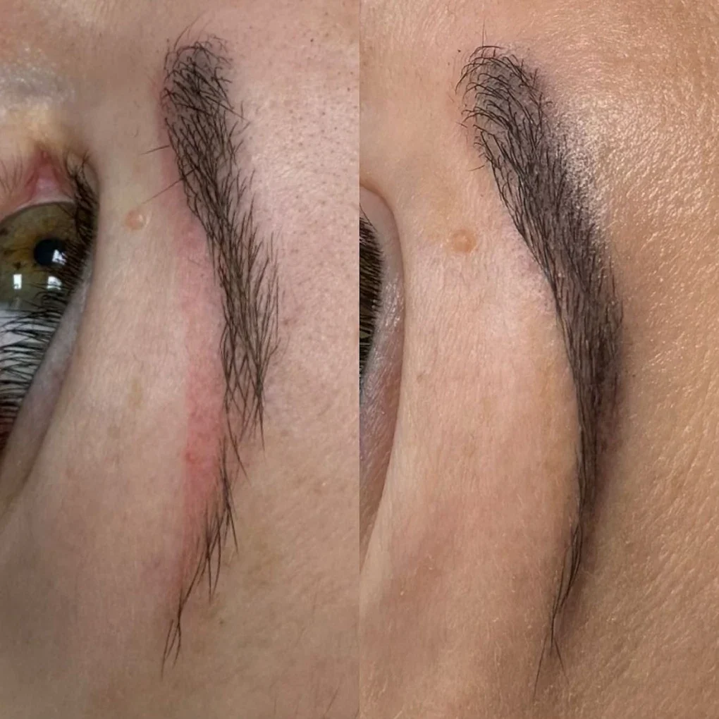 Efekt przed i po zabiegu w OG Cosmetology